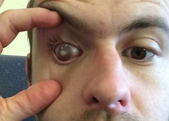 Мужчина принял душ в линзах и на один глаз ослеп